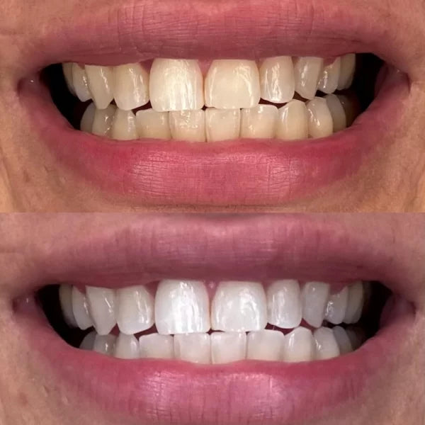 Crest 3D Whitestrips Glammourous Effects – Blanchiment Dentaire