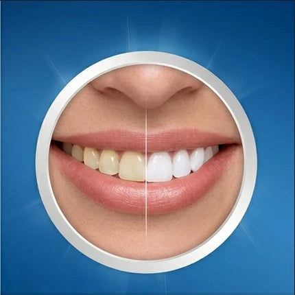 Vorher-Nachher-Vergleich eines Lächelns mit Crest 3D White